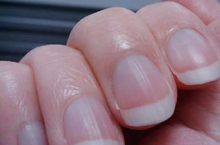 指甲上都是竖纹是什么原因(指甲有竖纹是身体的什么信号)